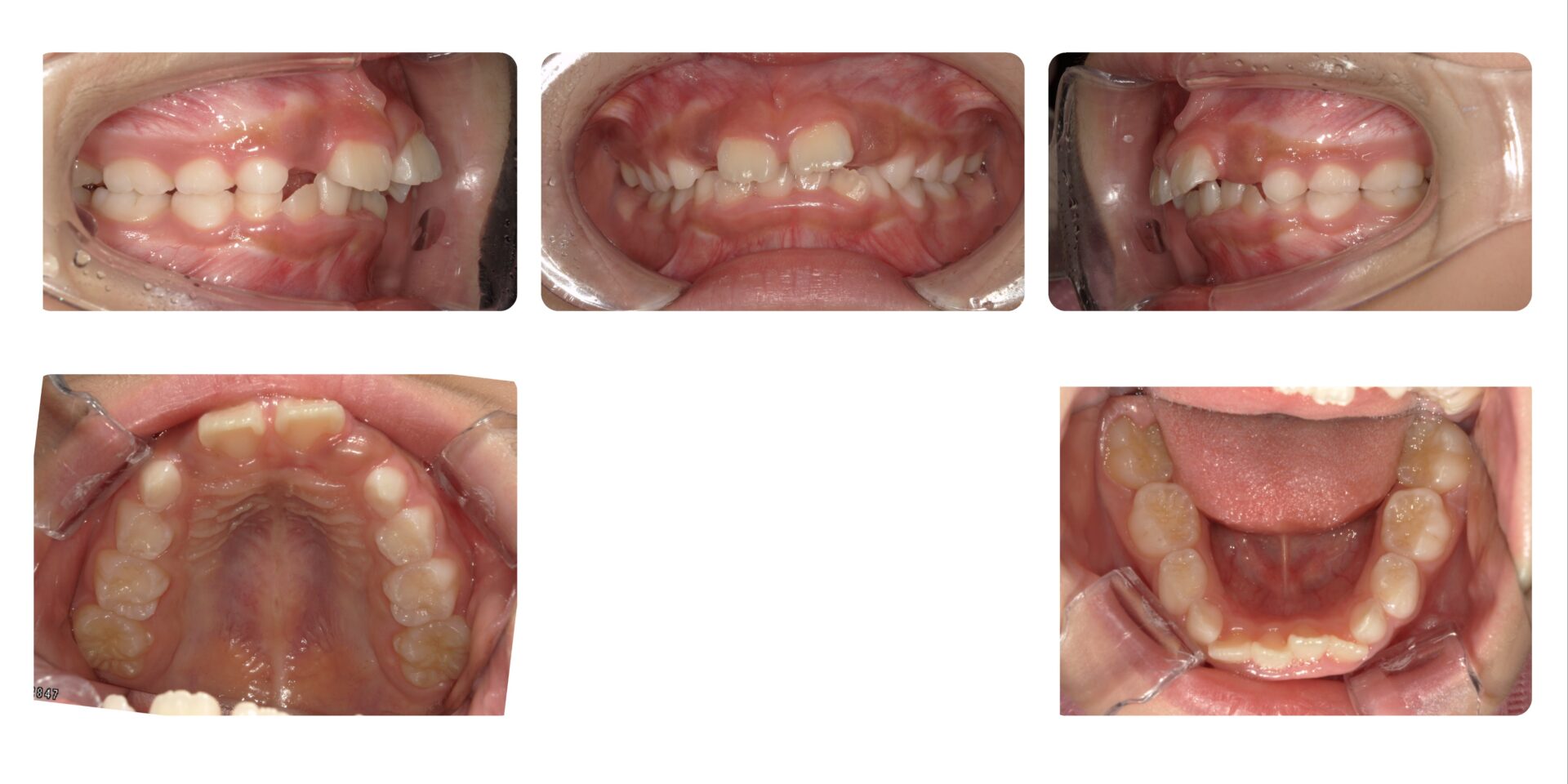 機能性反対咬合｜東大和 ソラハレ歯科・矯正歯科 | 症例紹介 | 【東大